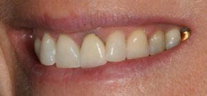 Single Teeth - Whitehouse Dental