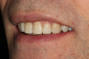 After 6 Month Smile - Whitehouse Dental
